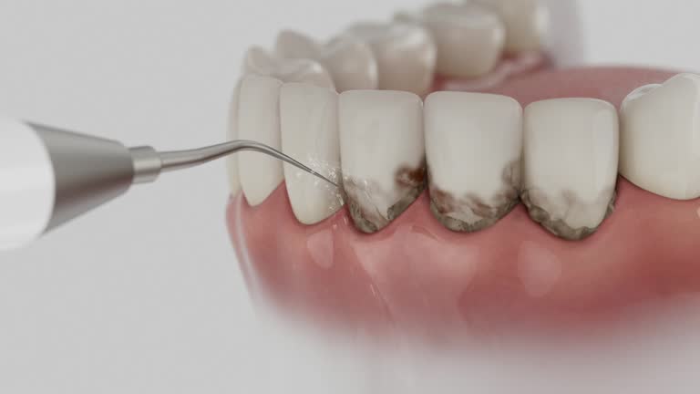 Reliable Dental Implants contractor in Abbeville, SC by Smile Center Dentistry